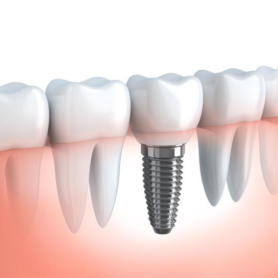 Lo que debe saber sobre los implantes dentales